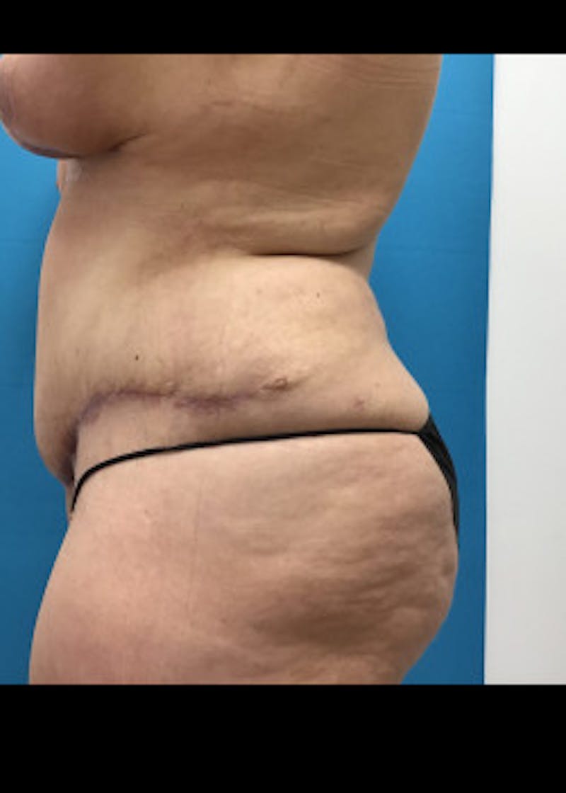 Liposuction Before & After Gallery - Patient 46613014 - Image 6