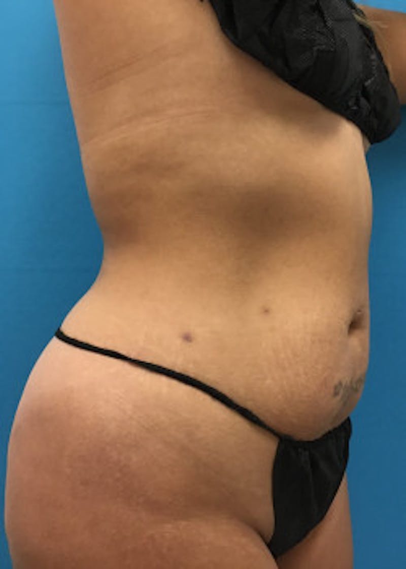 Liposuction Before & After Gallery - Patient 46613027 - Image 1