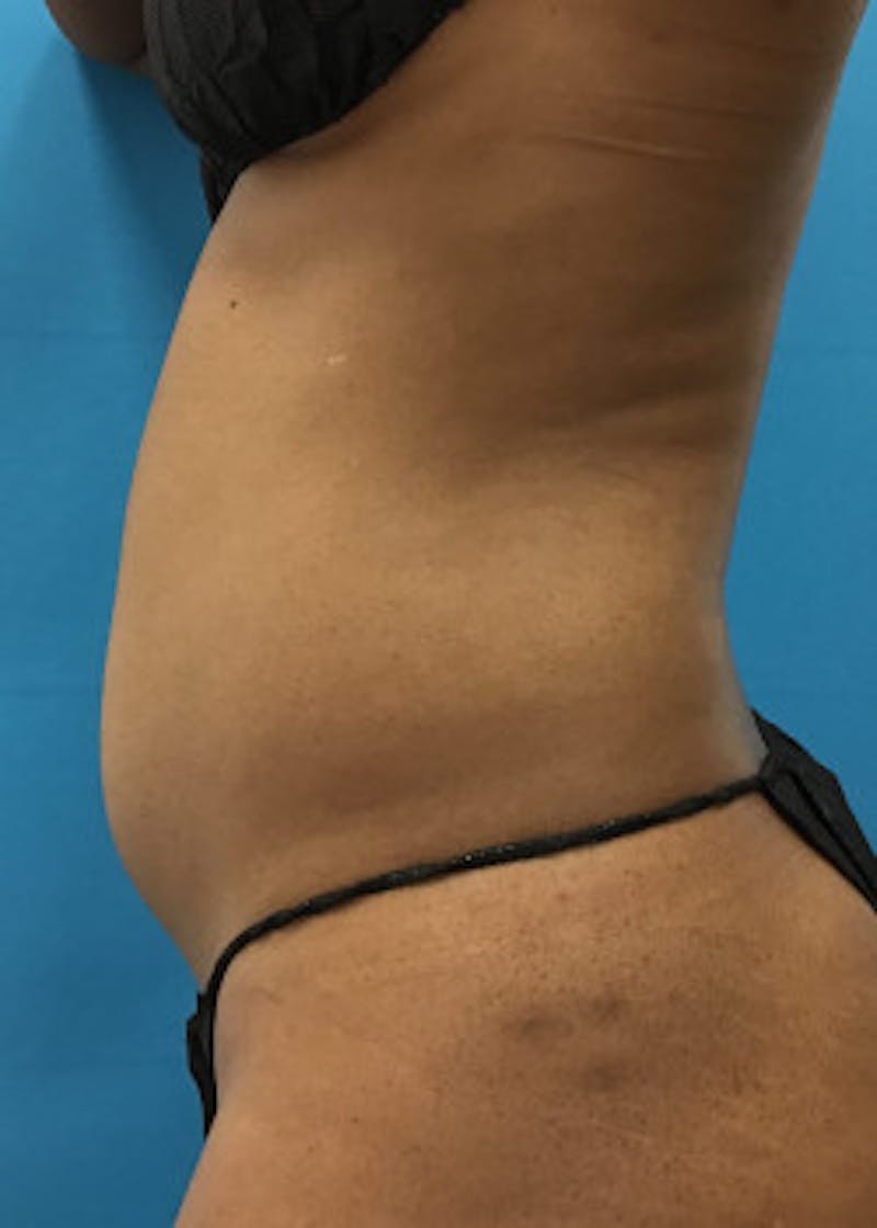 Liposuction Before & After Gallery - Patient 46613043 - Image 1