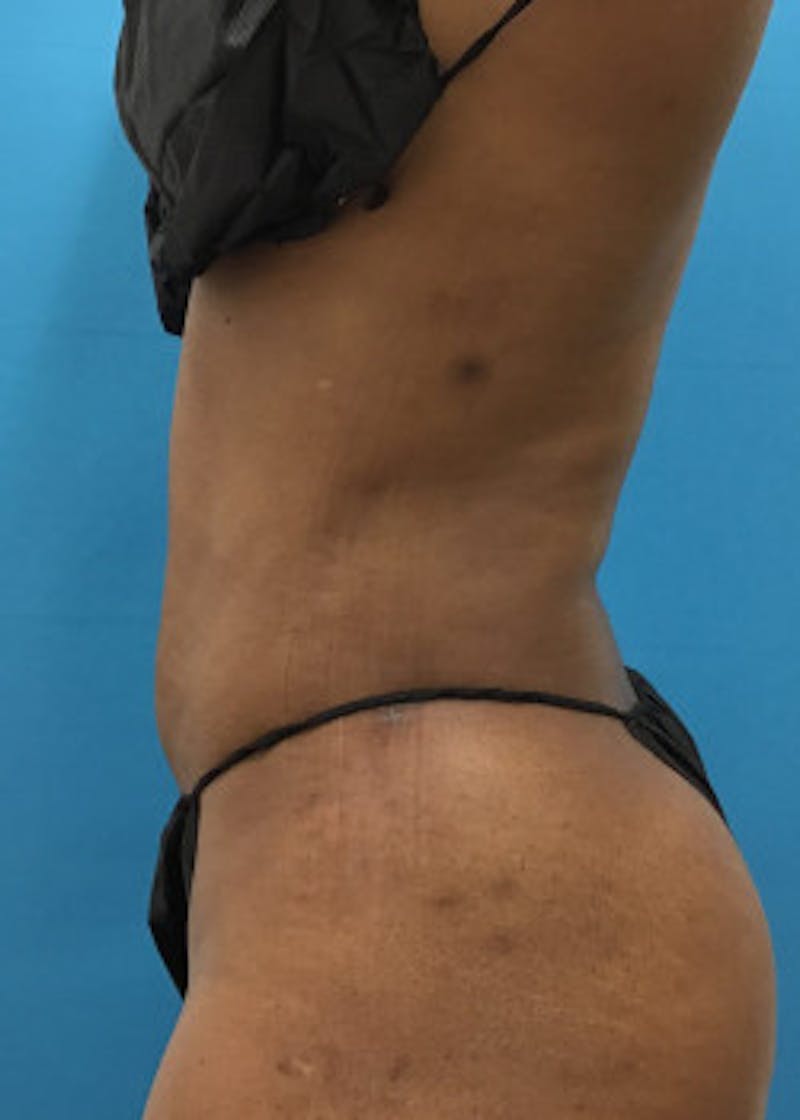 Liposuction Before & After Gallery - Patient 46613043 - Image 2