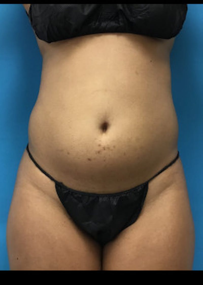 Liposuction Before & After Gallery - Patient 46613043 - Image 3