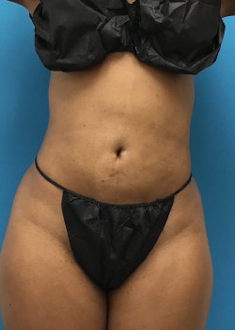 Liposuction Before & After Gallery - Patient 46613043 - Image 4