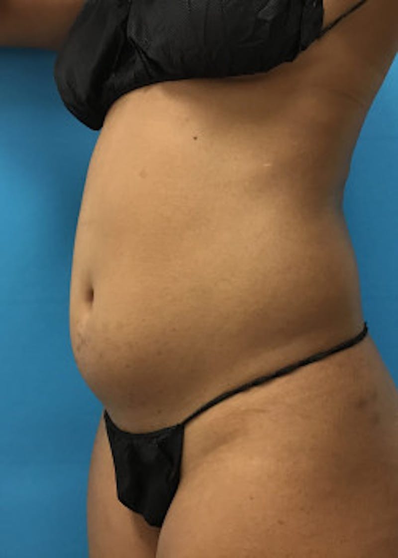Liposuction Before & After Gallery - Patient 46613043 - Image 5