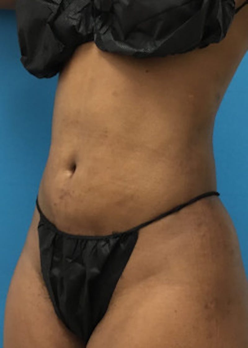 Liposuction Before & After Gallery - Patient 46613043 - Image 6
