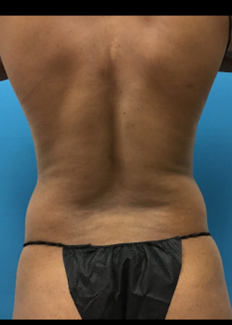 Liposuction Before & After Gallery - Patient 46613043 - Image 7