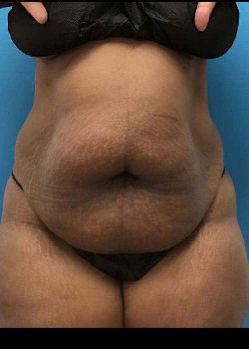 Liposuction Before & After Gallery - Patient 46613052 - Image 1