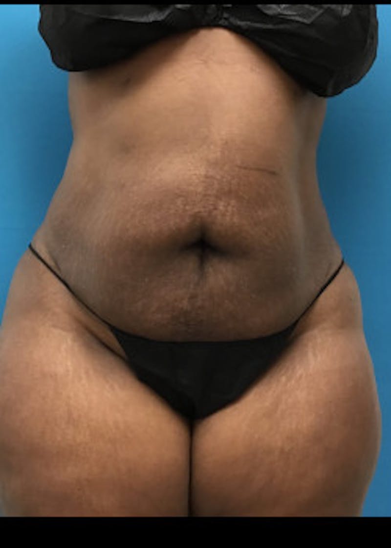 Liposuction Before & After Gallery - Patient 46613052 - Image 2