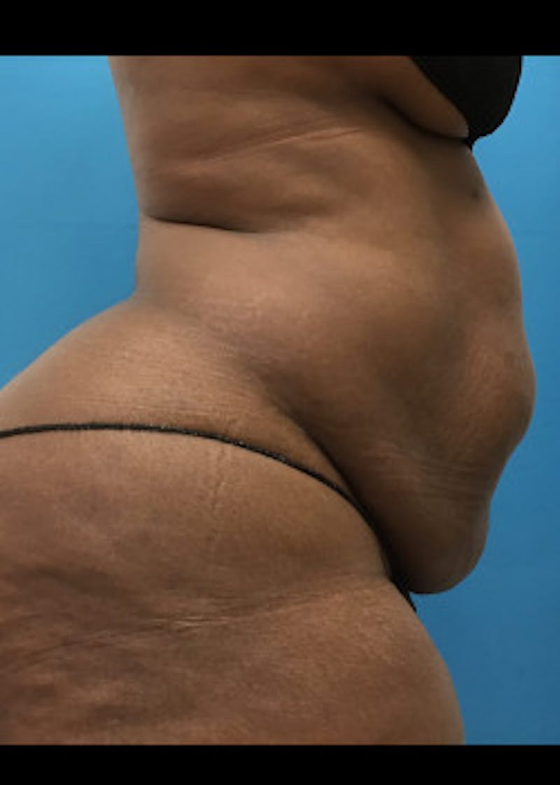 Liposuction Before & After Gallery - Patient 46613052 - Image 3