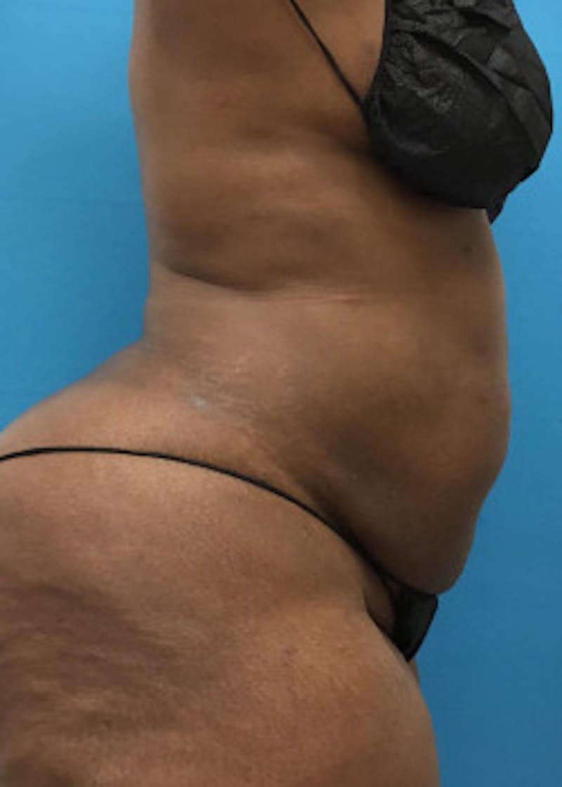 Liposuction Before & After Gallery - Patient 46613052 - Image 4