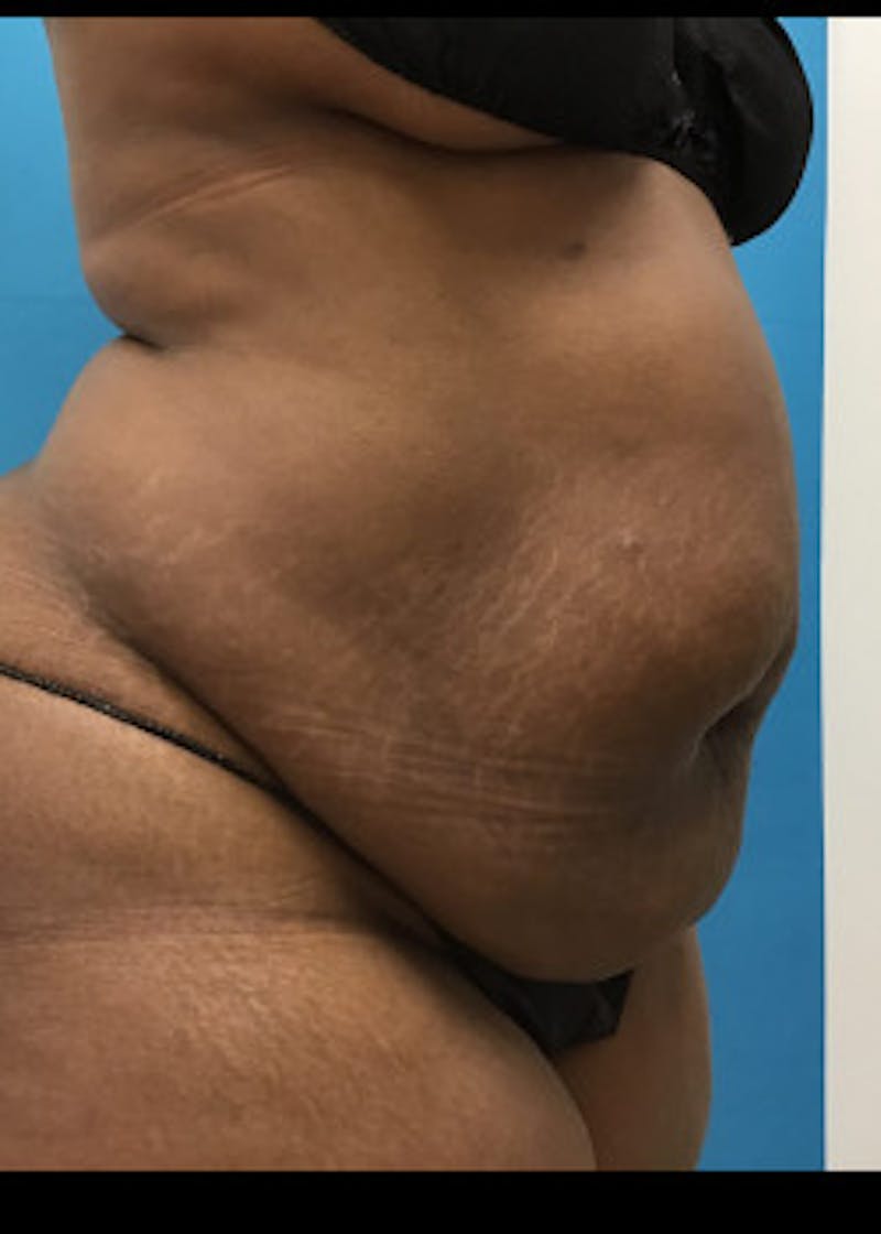 Liposuction Before & After Gallery - Patient 46613052 - Image 5