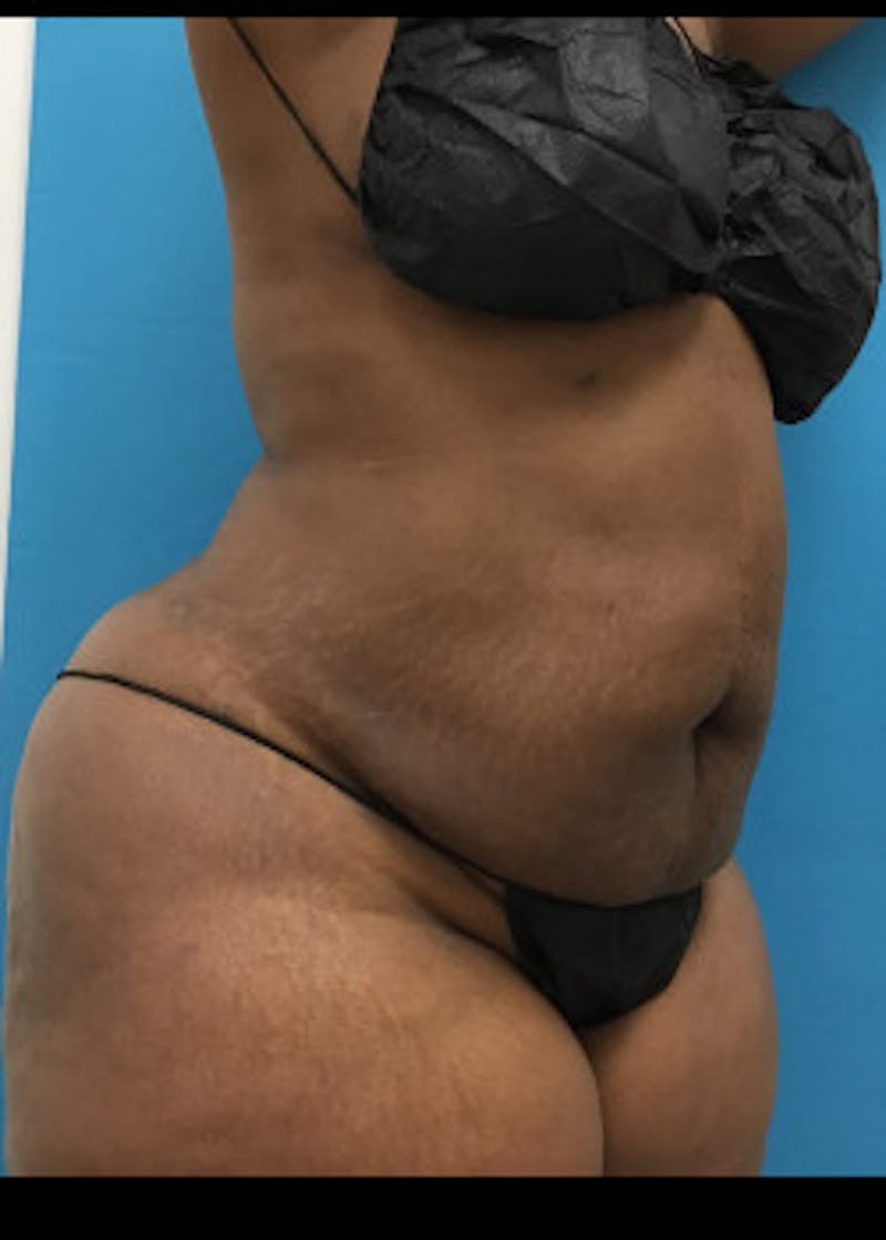 Liposuction Before & After Gallery - Patient 46613052 - Image 6
