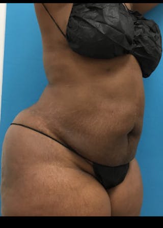 Liposuction Before & After Gallery - Patient 46613052 - Image 6