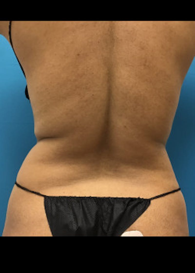 Liposuction Before & After Gallery - Patient 46613059 - Image 1