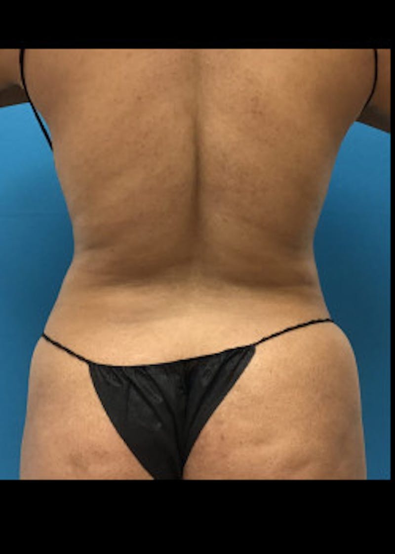 Liposuction Before & After Gallery - Patient 46613059 - Image 2