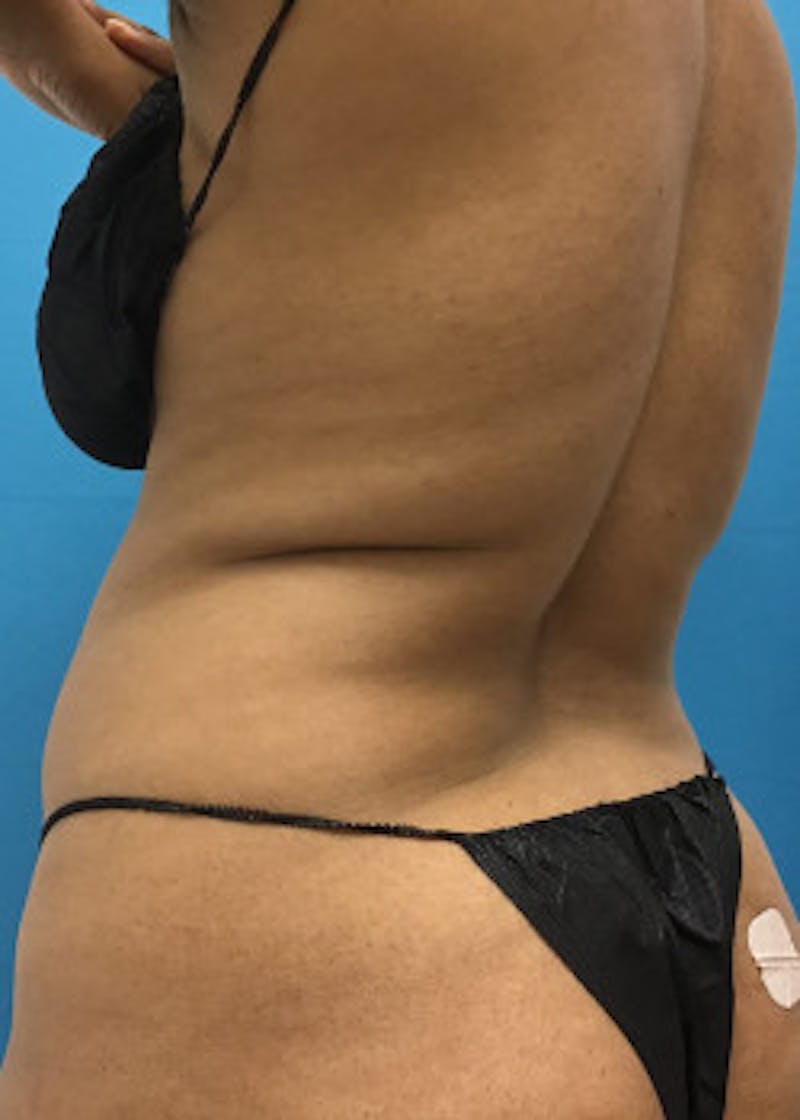 Liposuction Before & After Gallery - Patient 46613059 - Image 3