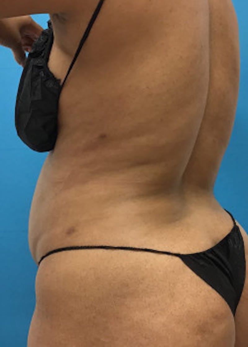 Liposuction Before & After Gallery - Patient 46613059 - Image 4