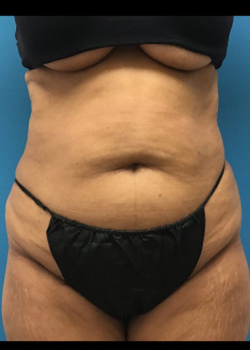 Liposuction Before & After Gallery - Patient 46613069 - Image 1