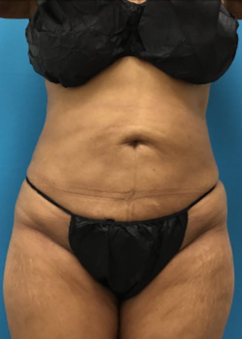Liposuction Before & After Gallery - Patient 46613069 - Image 2