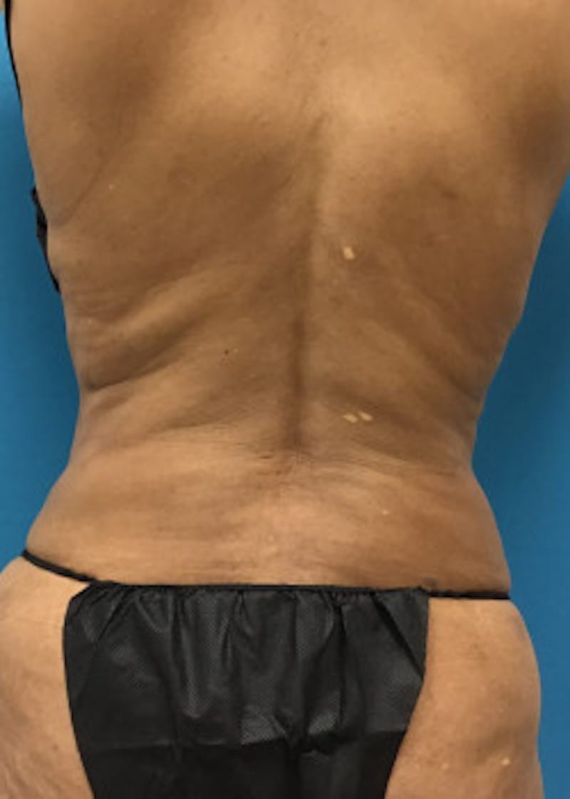 Liposuction Before & After Gallery - Patient 46613069 - Image 4