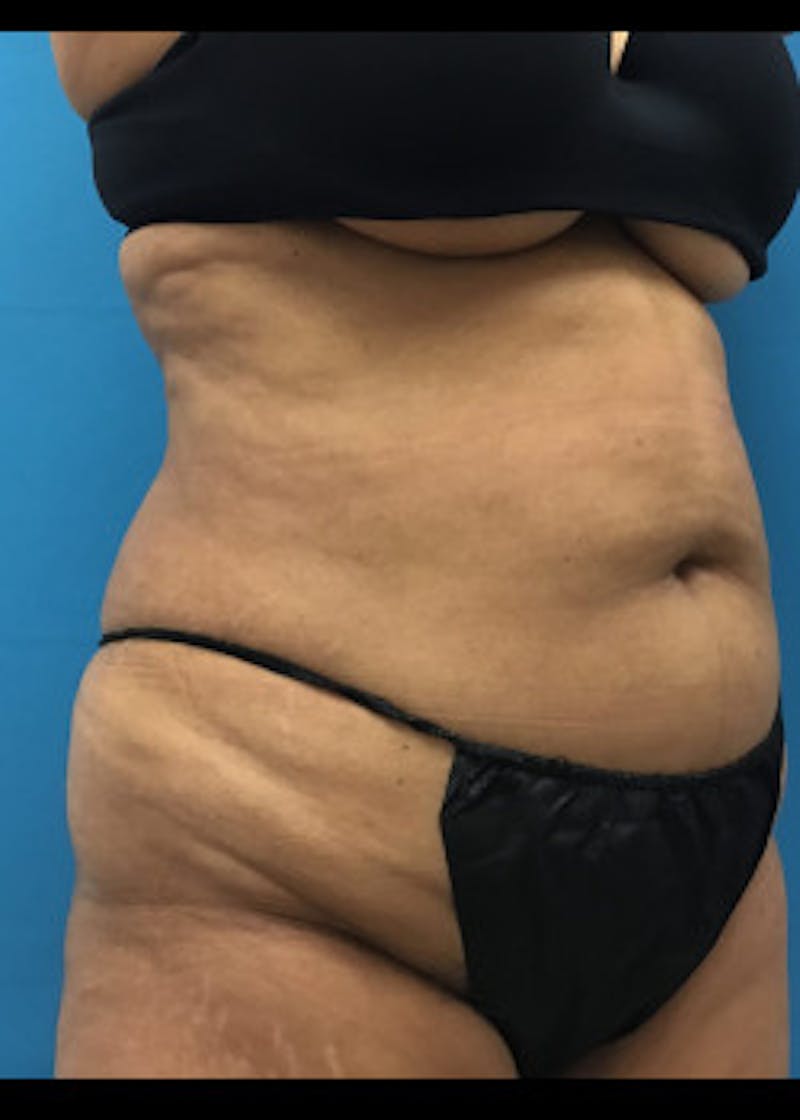Liposuction Before & After Gallery - Patient 46613069 - Image 5