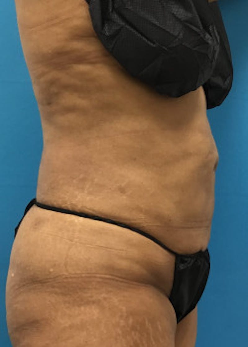 Liposuction Before & After Gallery - Patient 46613069 - Image 6