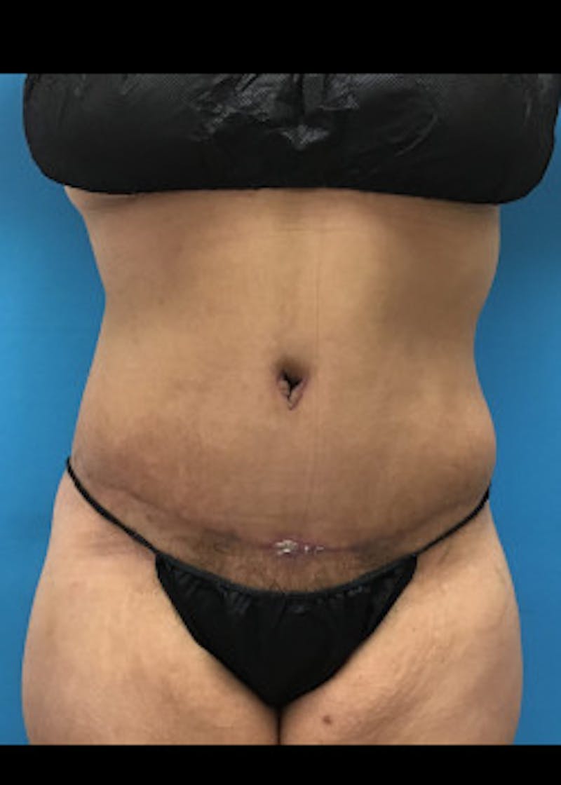 Liposuction Before & After Gallery - Patient 46613077 - Image 4