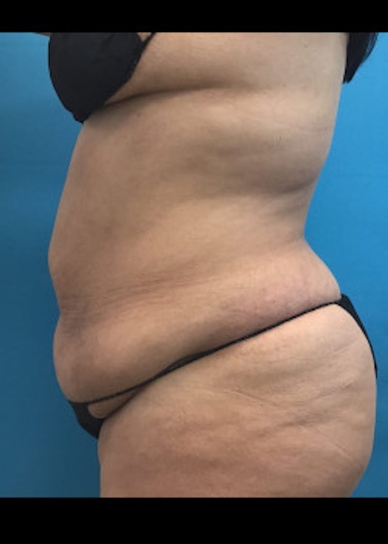 Liposuction Before & After Gallery - Patient 46613077 - Image 5