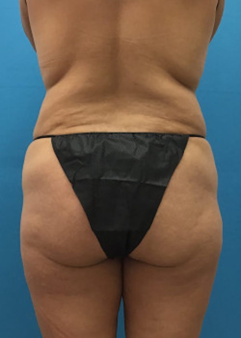 Liposuction Before & After Gallery - Patient 46613080 - Image 1