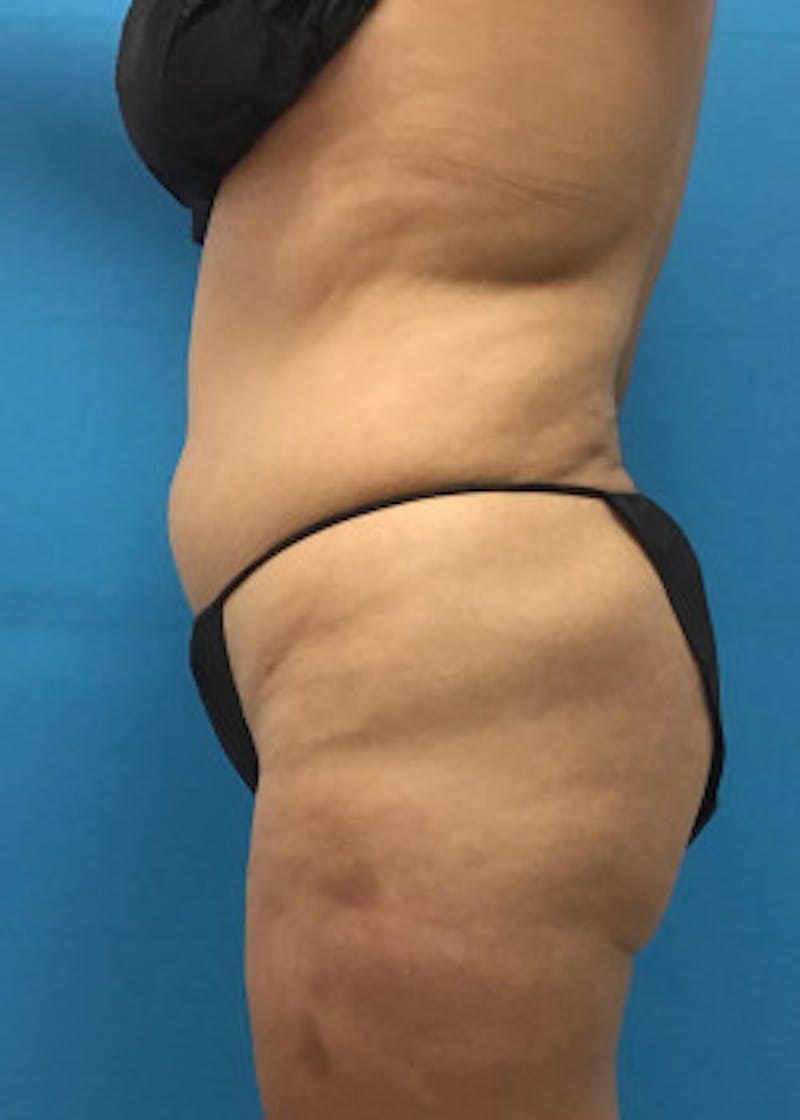 Liposuction Before & After Gallery - Patient 46613080 - Image 3