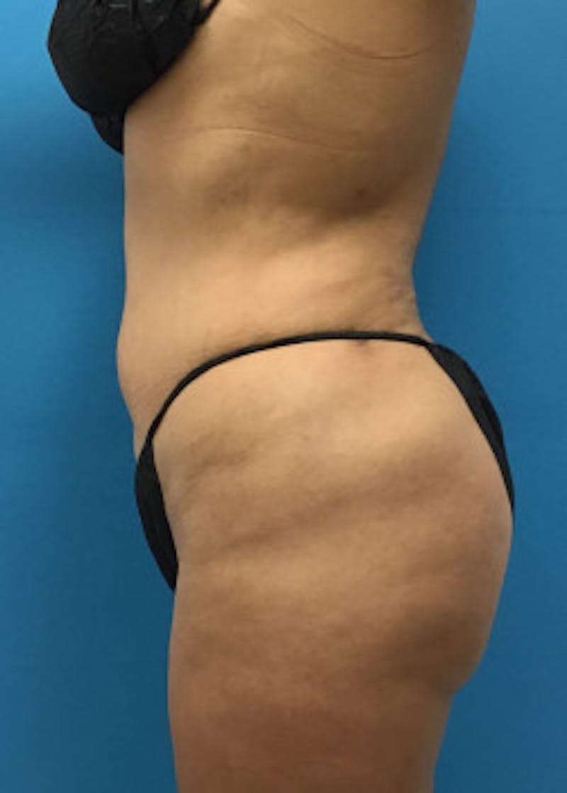 Liposuction Before & After Gallery - Patient 46613080 - Image 4