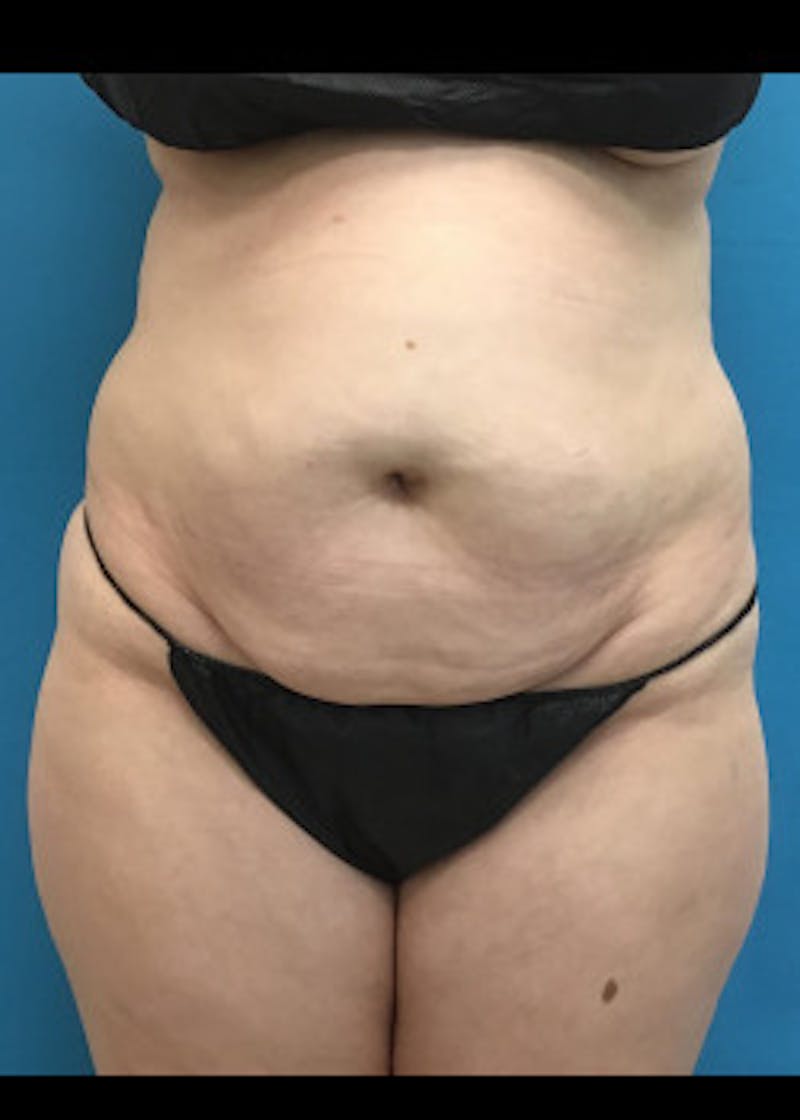 Liposuction Before & After Gallery - Patient 46613088 - Image 1
