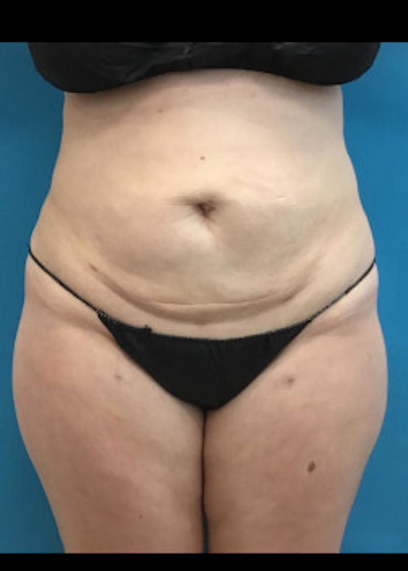 Liposuction Before & After Gallery - Patient 46613088 - Image 2