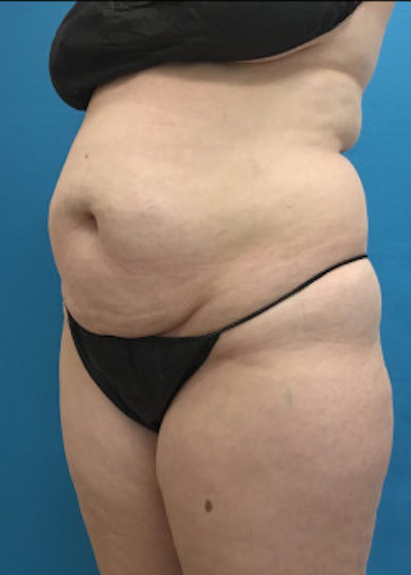 Liposuction Before & After Gallery - Patient 46613088 - Image 3