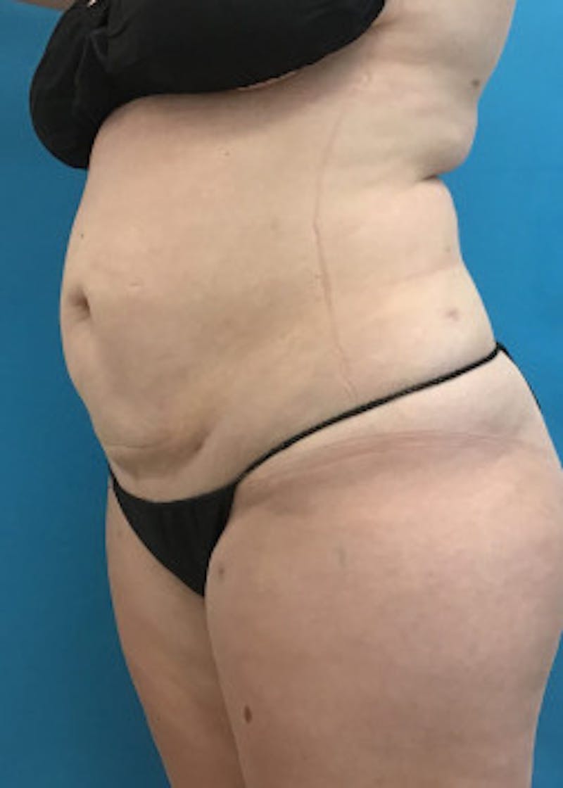 Liposuction Before & After Gallery - Patient 46613088 - Image 4