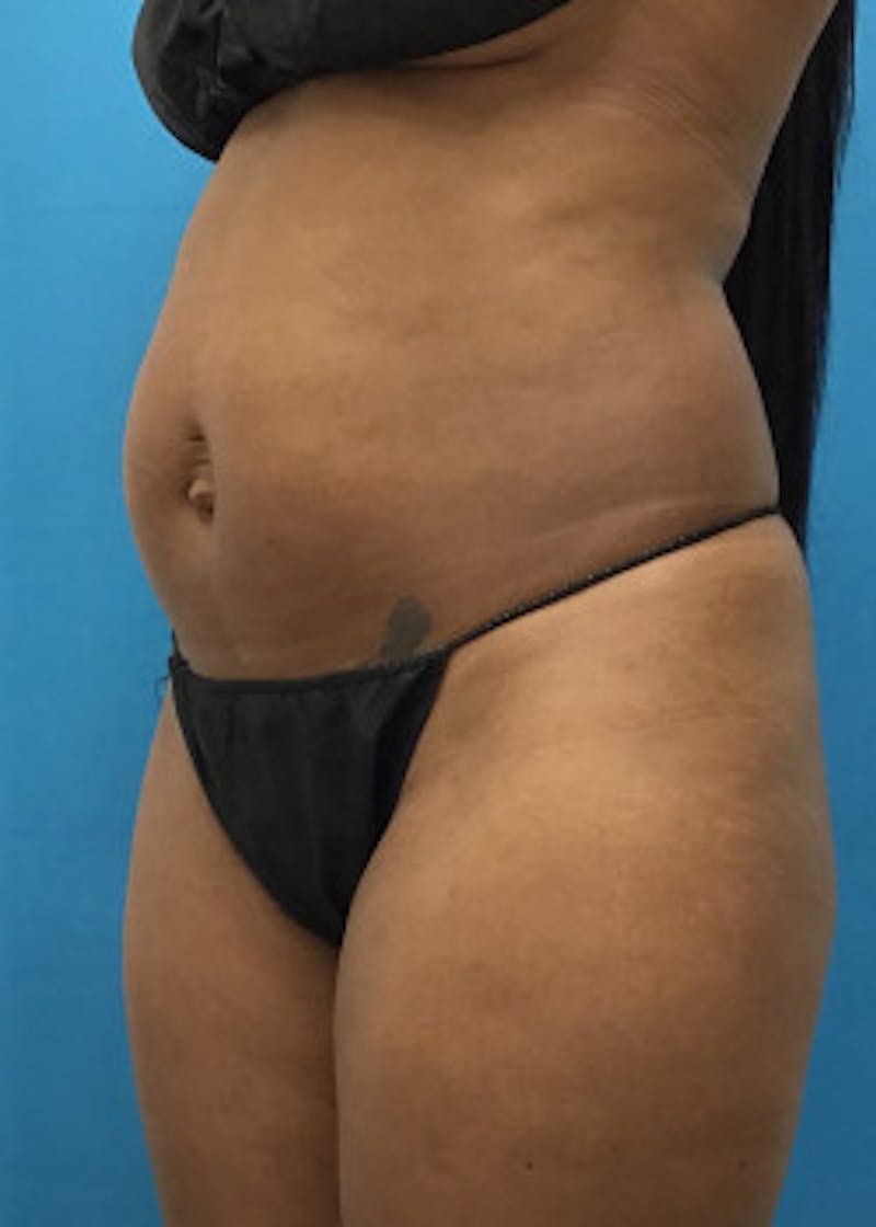 Liposuction Before & After Gallery - Patient 46613129 - Image 3