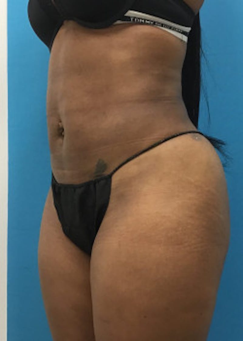 Liposuction Before & After Gallery - Patient 46613129 - Image 4