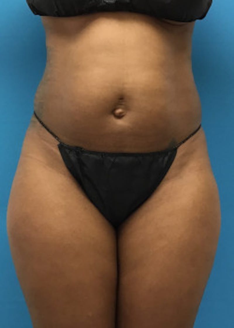 Liposuction Before & After Gallery - Patient 46613129 - Image 5