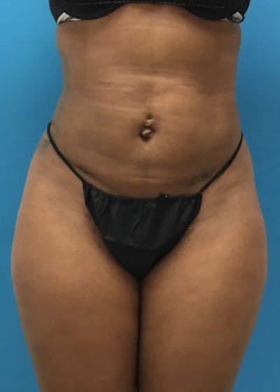 Liposuction Before & After Gallery - Patient 46613129 - Image 2