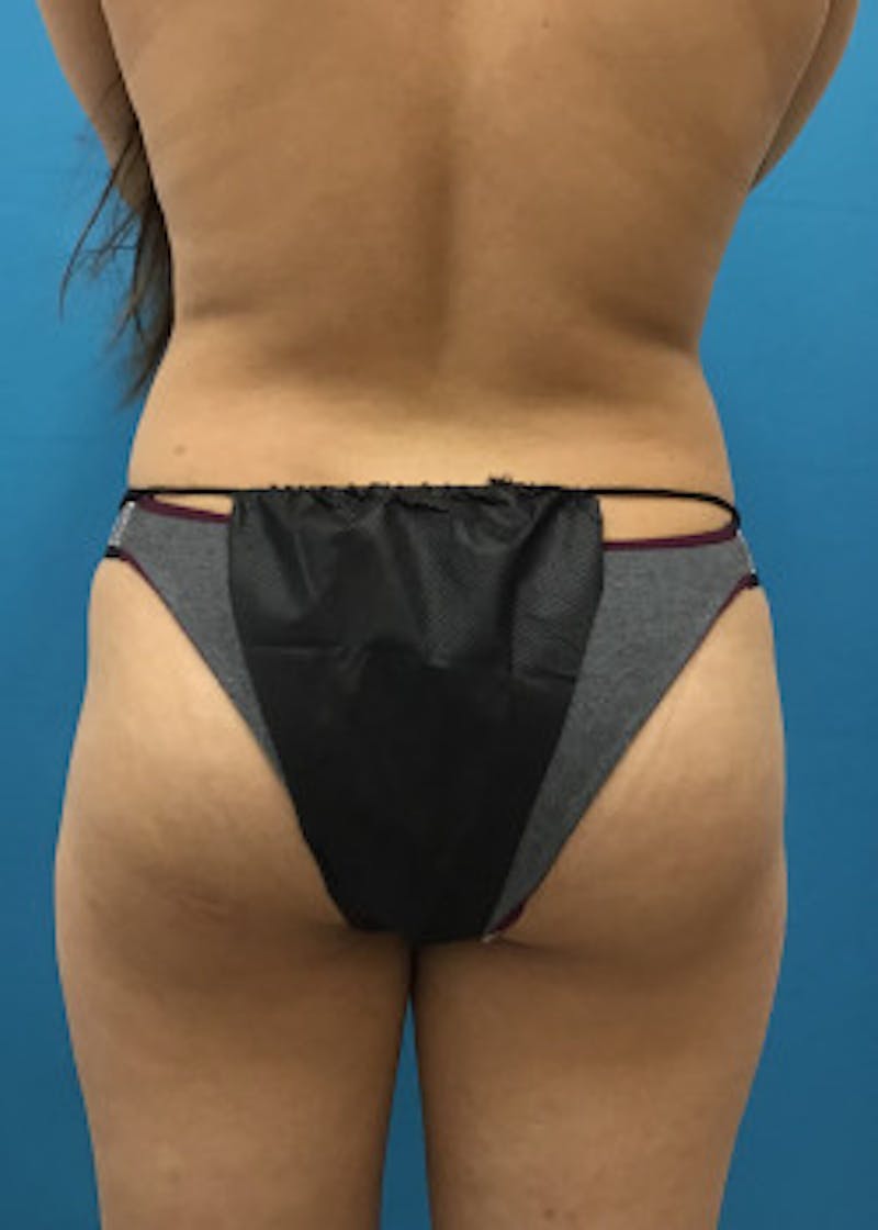 Liposuction Before & After Gallery - Patient 46613139 - Image 1