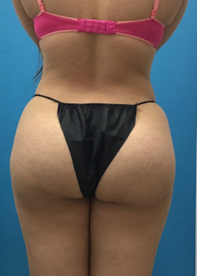 Liposuction Before & After Gallery - Patient 46613139 - Image 2