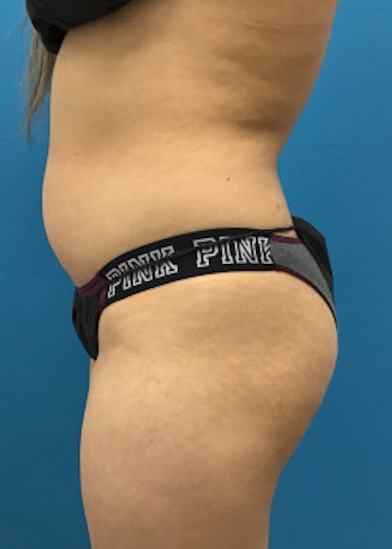 Liposuction Before & After Gallery - Patient 46613139 - Image 3