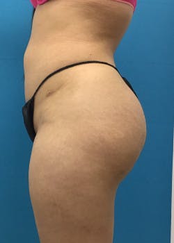 Liposuction Gallery - Patient 46613139 - Image 4