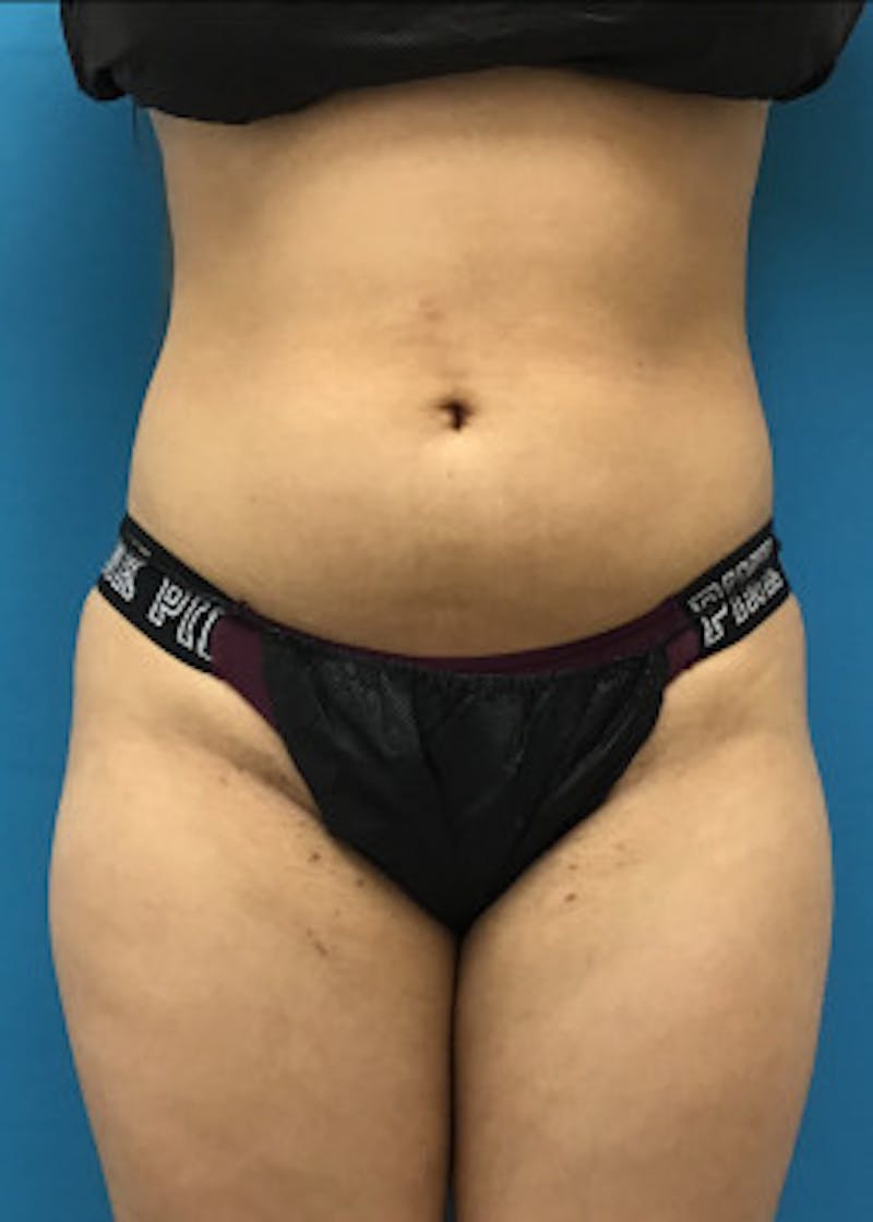 Liposuction Before & After Gallery - Patient 46613139 - Image 5