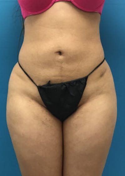 Liposuction Before & After Gallery - Patient 46613139 - Image 2