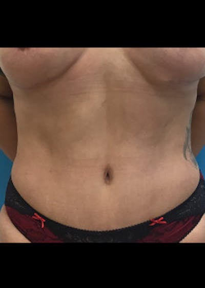 Liposuction Before & After Gallery - Patient 46613146 - Image 2
