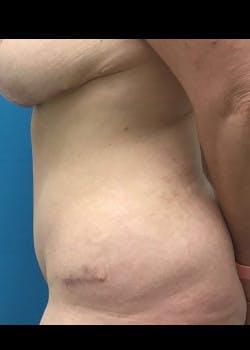 Liposuction Gallery - Patient 46613151 - Image 2
