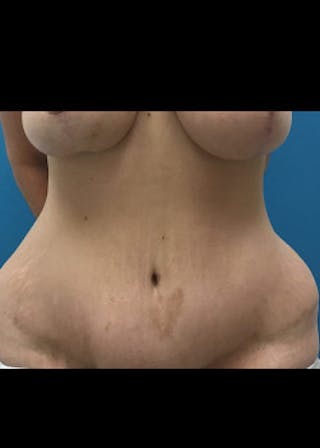 Liposuction Before & After Gallery - Patient 46613151 - Image 2