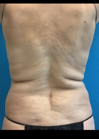 Liposuction Before & After Gallery - Patient 46613161 - Image 1