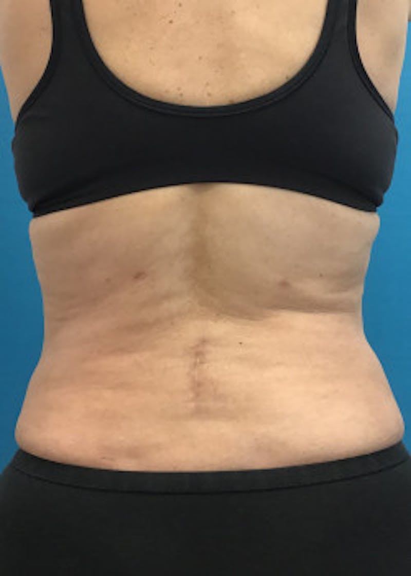 Liposuction Before & After Gallery - Patient 46613161 - Image 4