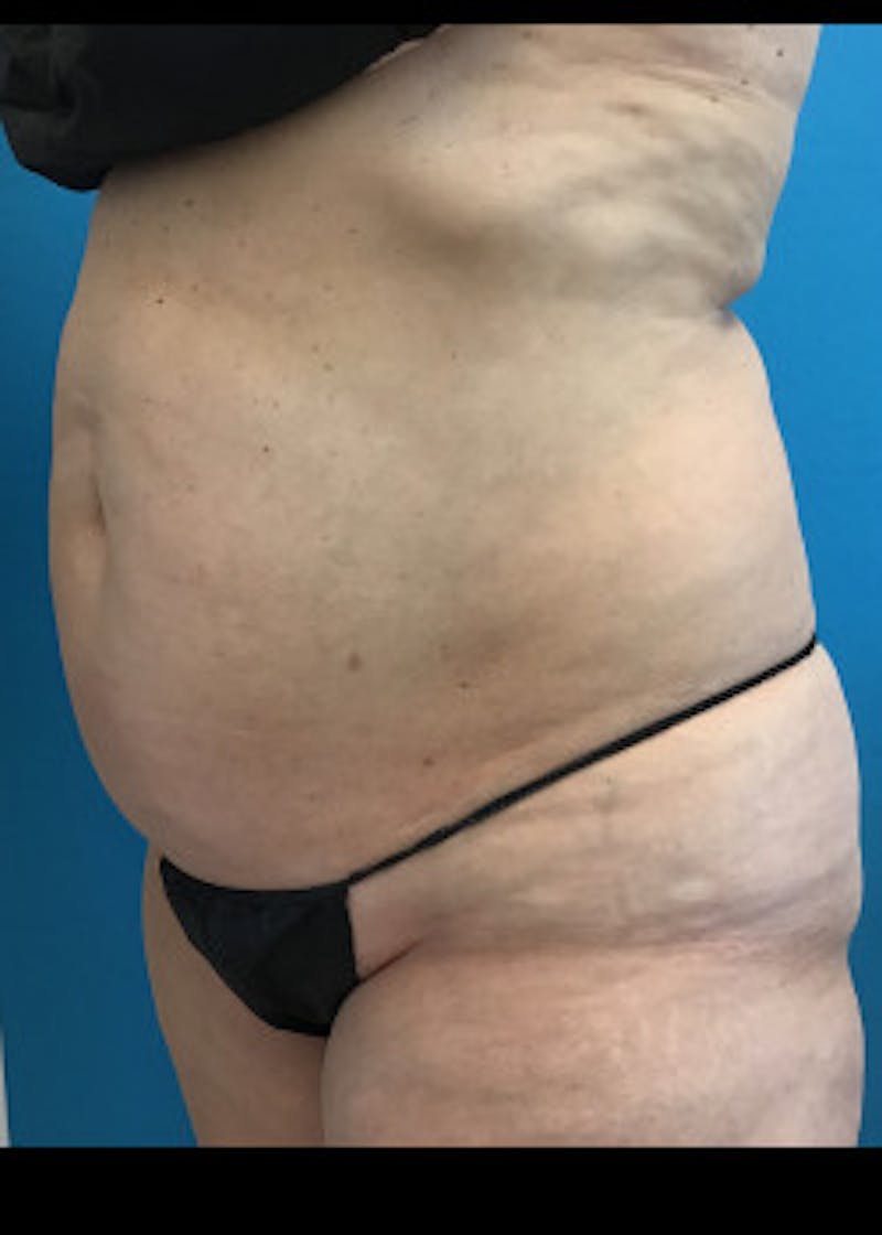 Liposuction Before & After Gallery - Patient 46613161 - Image 5